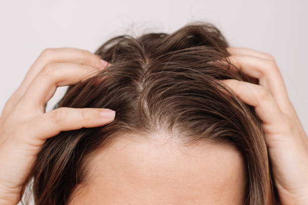 How to Manage Greasy Hair: Tips and Tricks for a Fresh Look